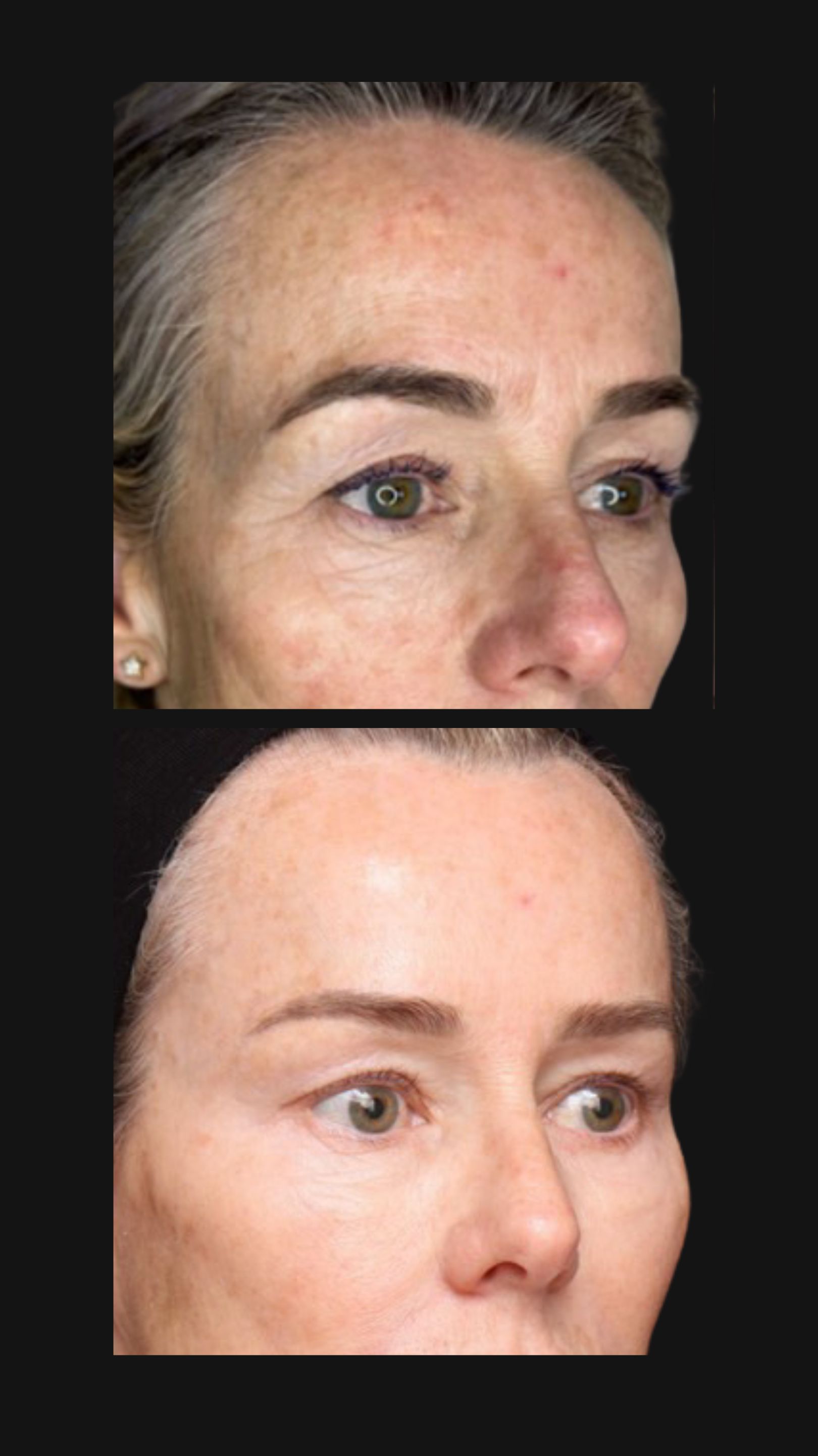 CO₂ Laser Resurfacing: Understanding Treatment Depth, Recovery and Patient Selection